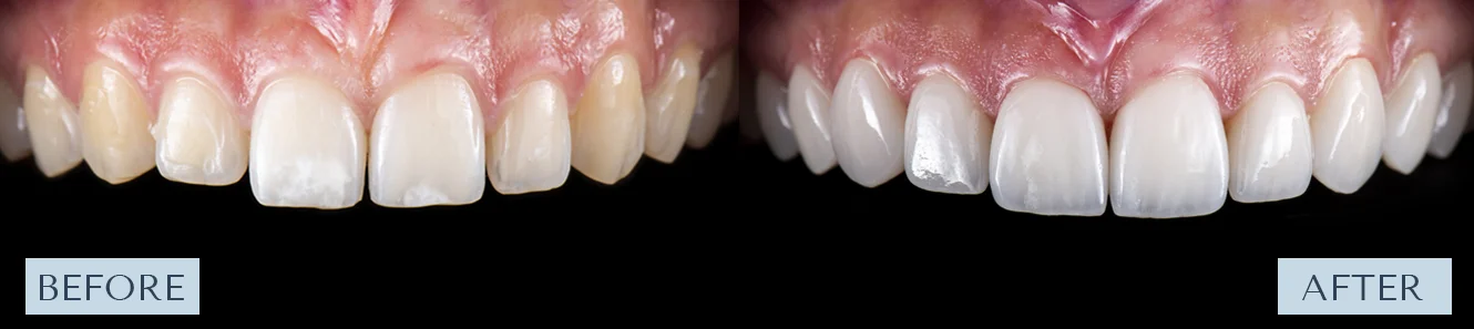 Before & After Porcelain Veneers Patient Smile Makeover