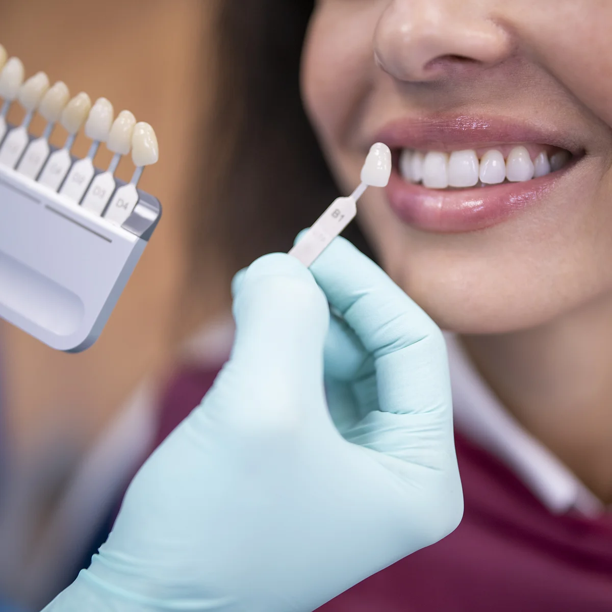 Color Matching for Porcelain Veneers Process