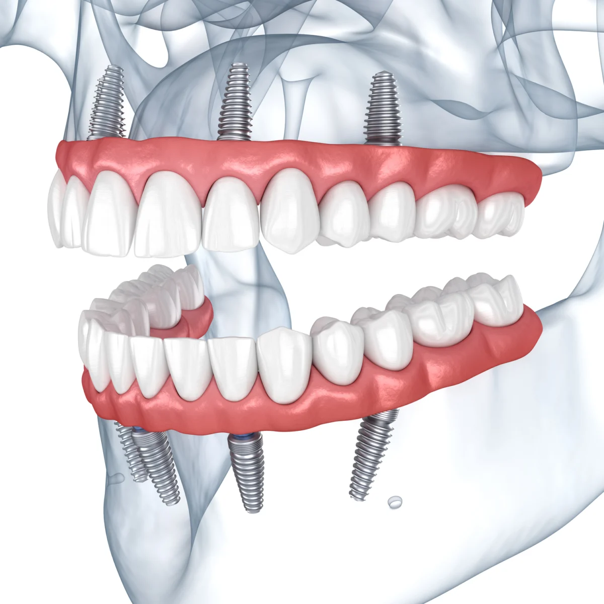All-On-4 Dental Implant 3D Model