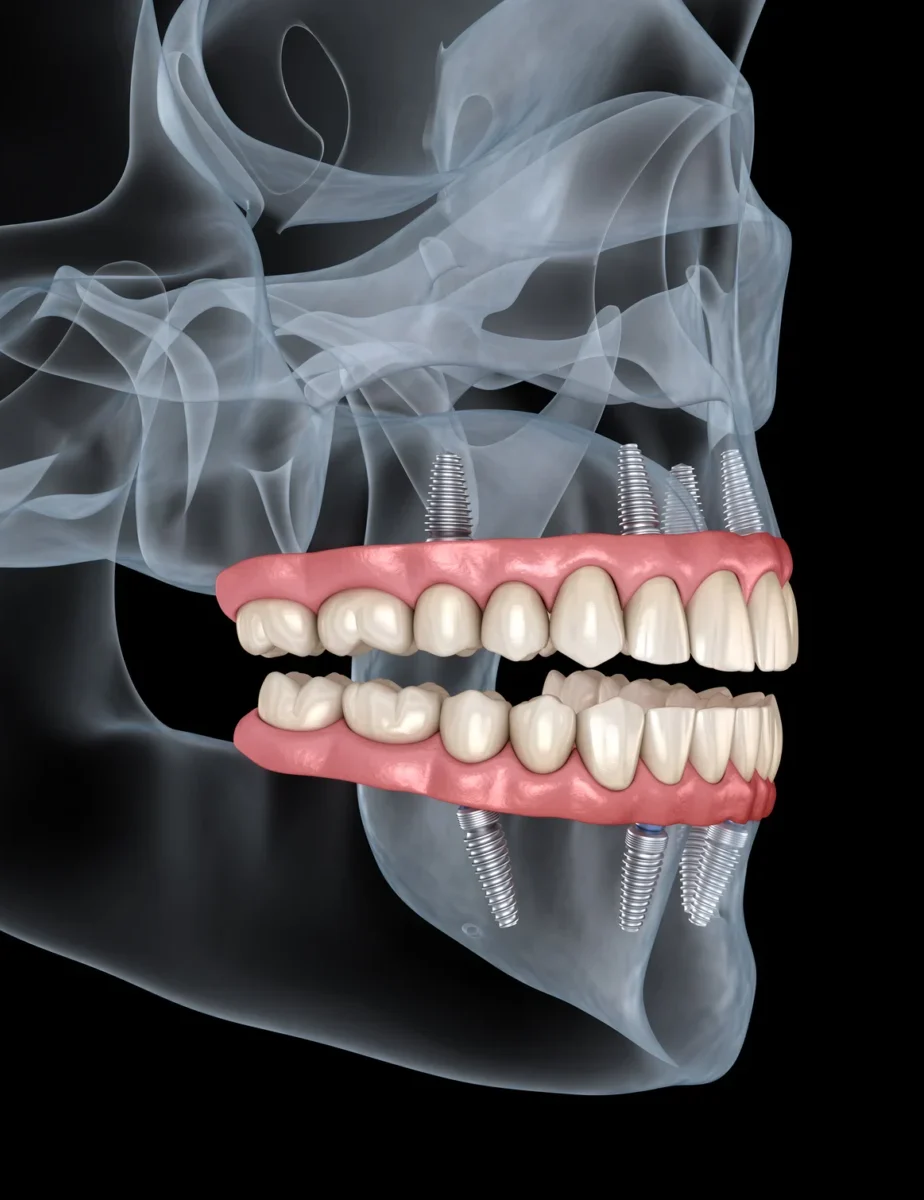 All-On-4 Dental Implants