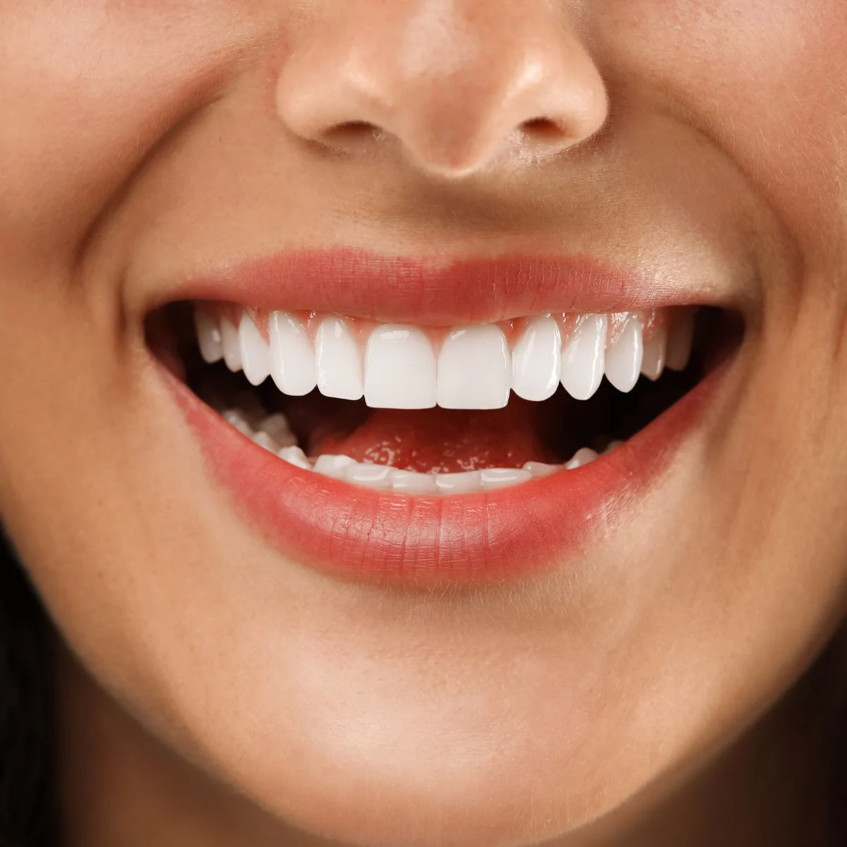 Beautiful Smile With Lumineers