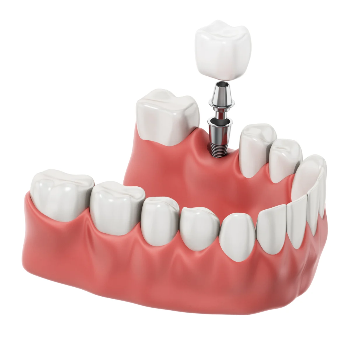 Dental Implant 3D Model