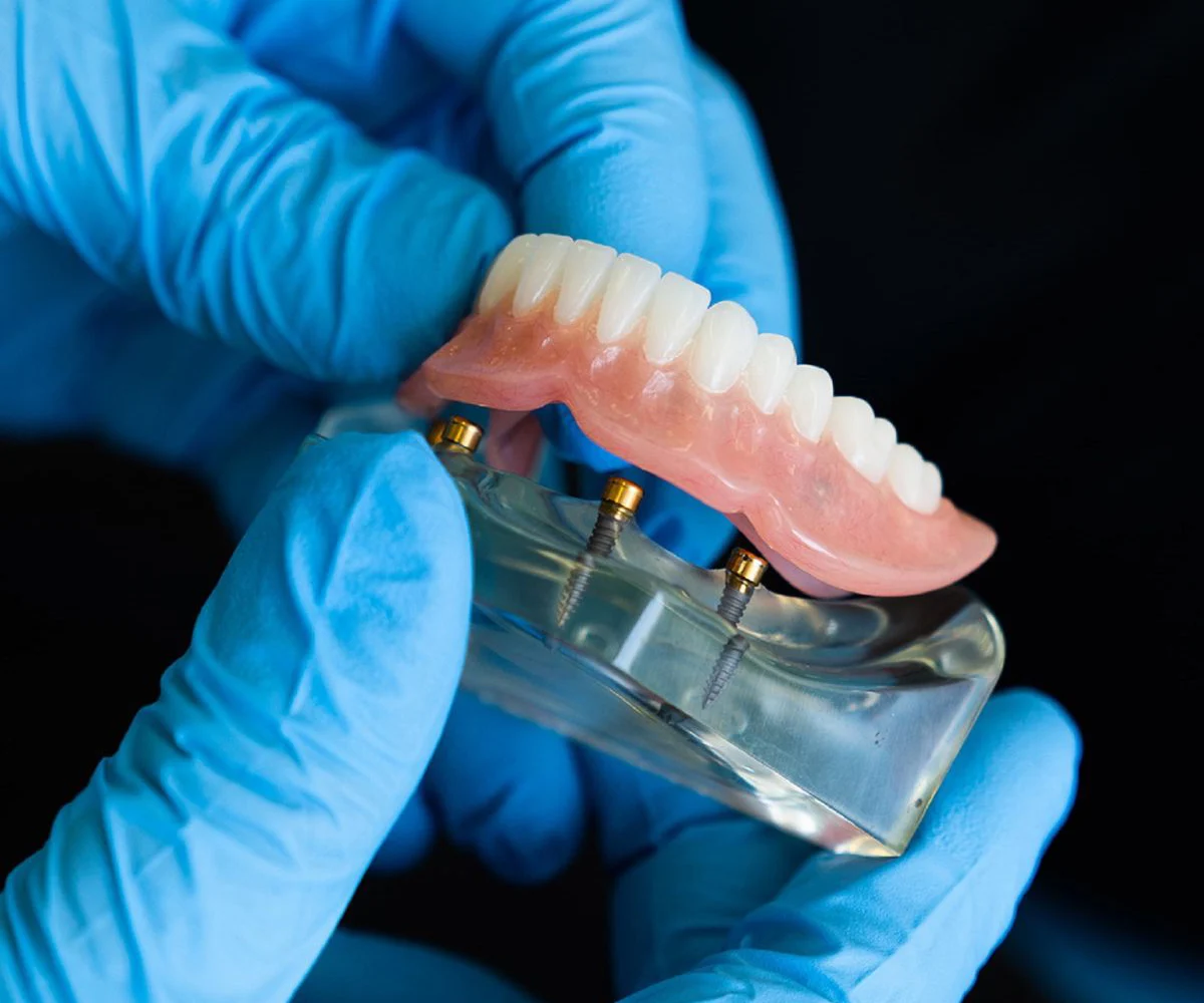 Implant-Supported Dentures Model