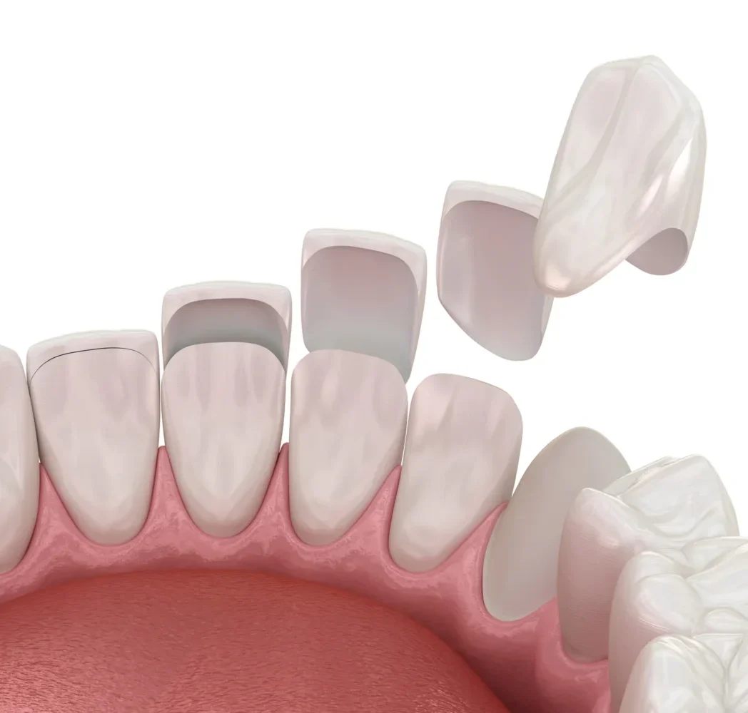 Porcelain Veneers Model