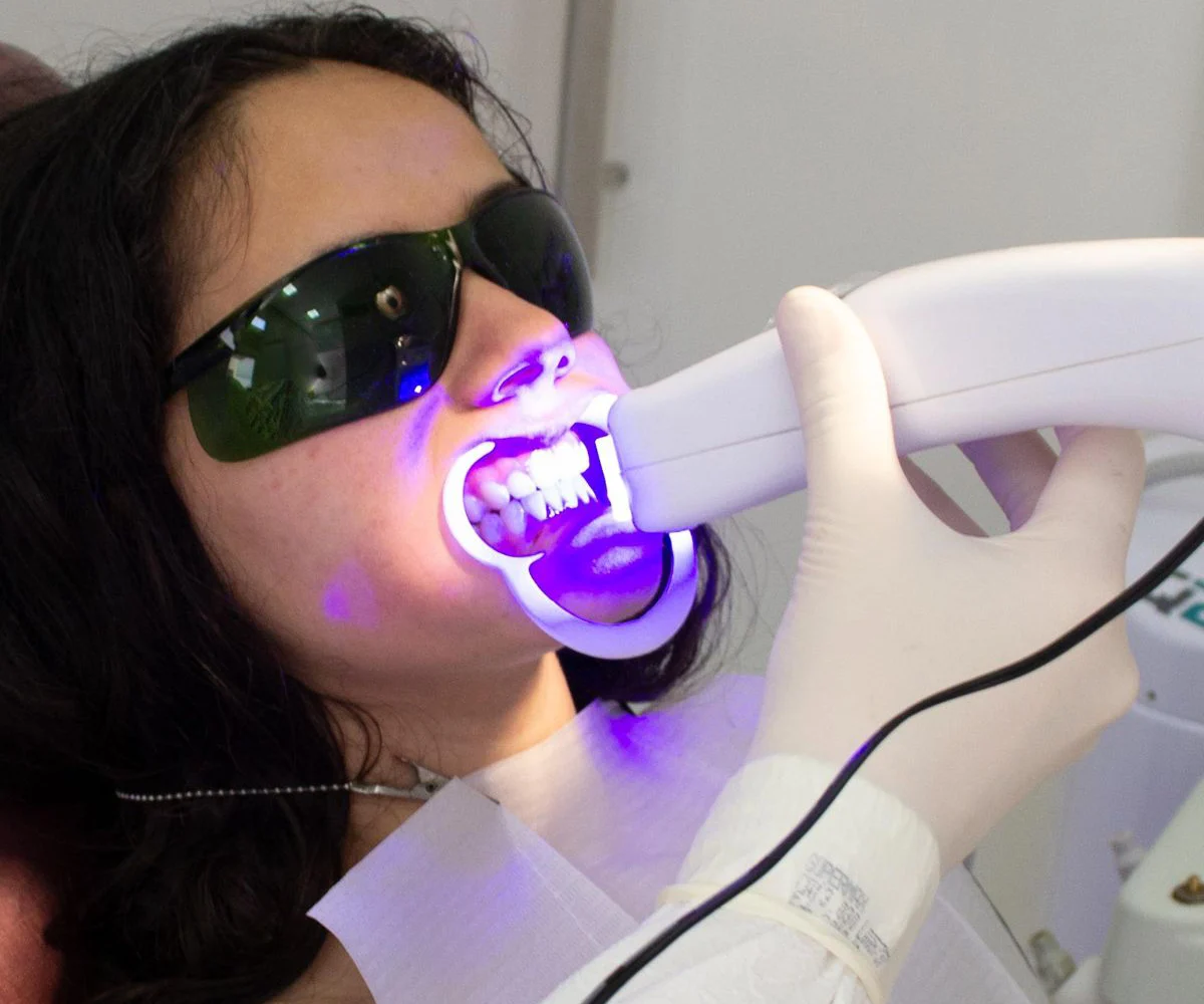 Professional Teeth Whitening Service