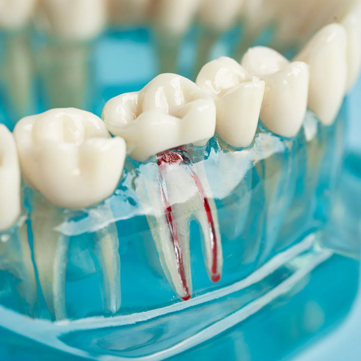 Root Canal Model