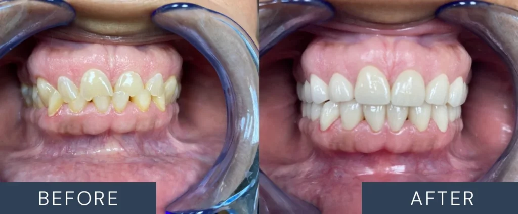 Before & After Dental Crowns Patient