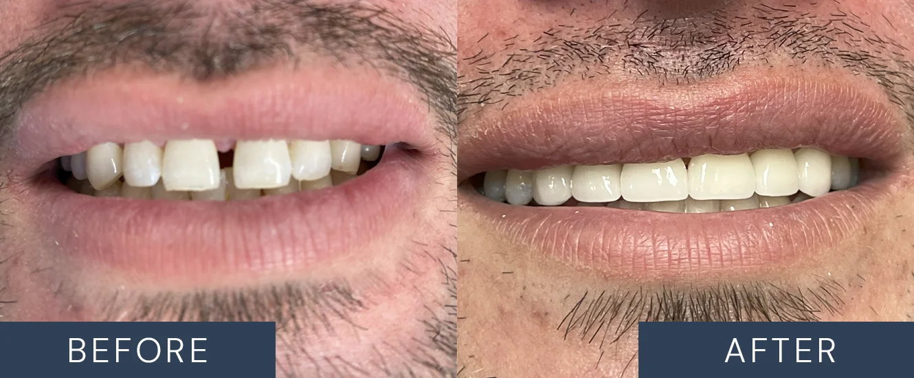 Before & After Porcelain Veneers Patient