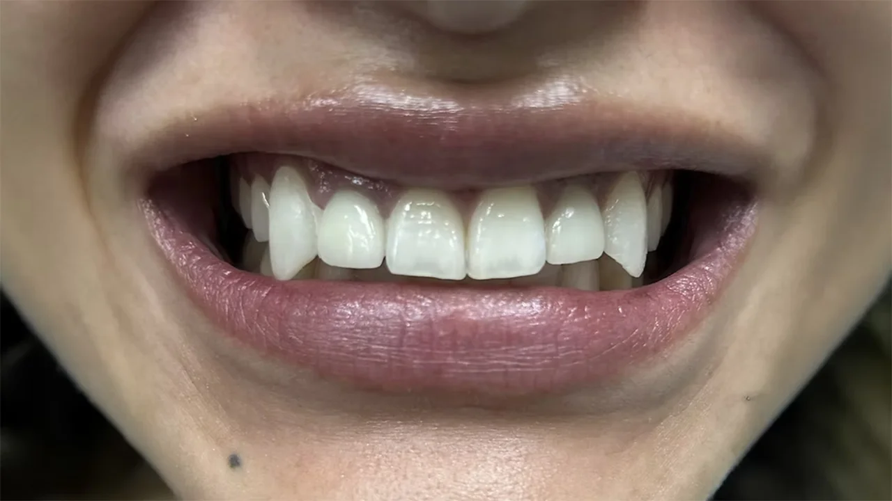 Dental Fangs Treatment