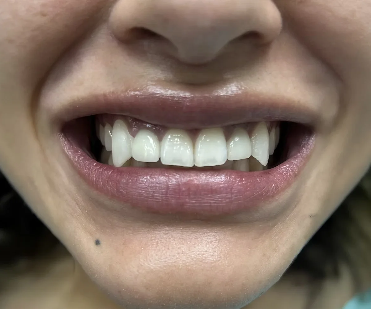 Dental Fangs Treatment