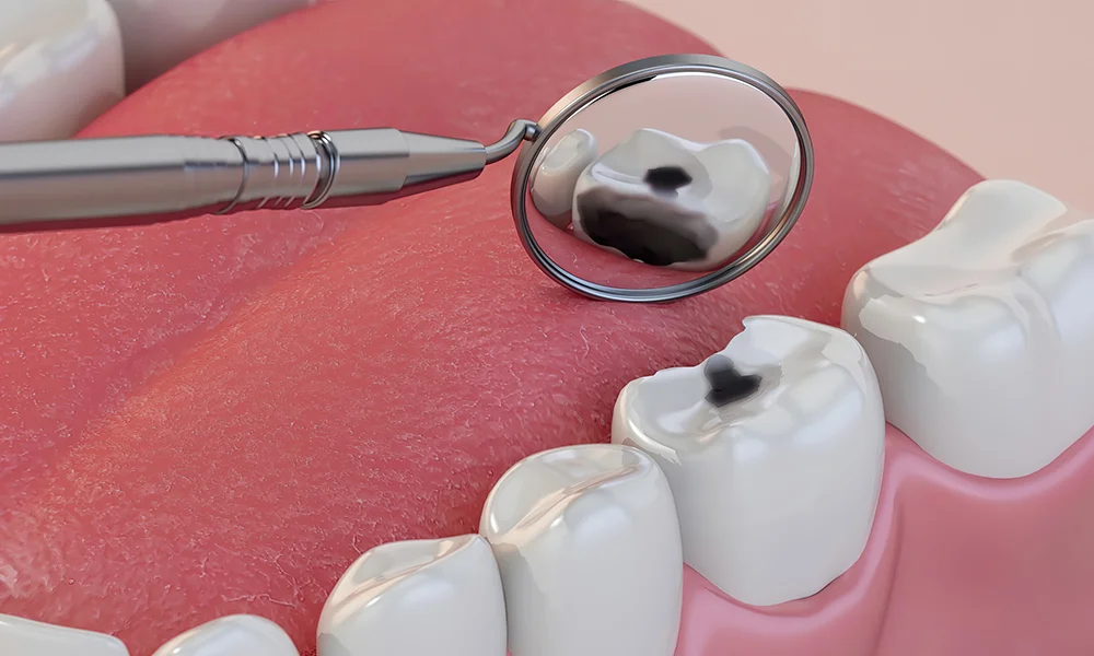 Dental Fillings