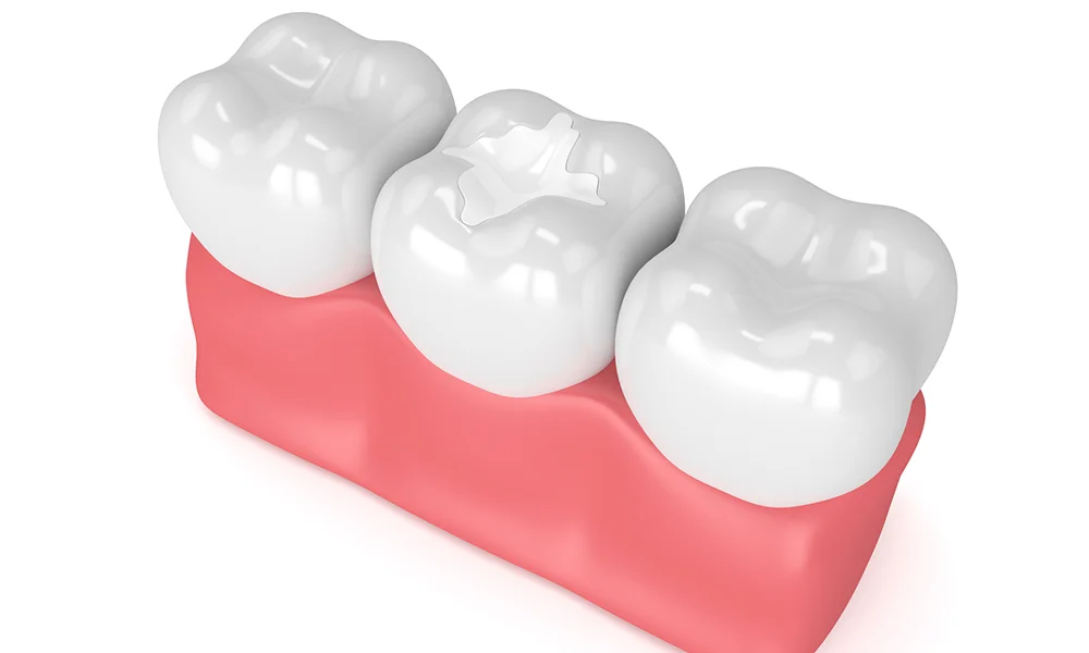 Dental Sealants Illustration