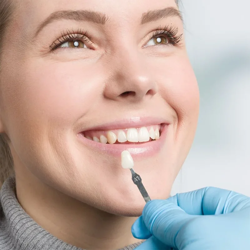 Dentist Color Matching Lumineers