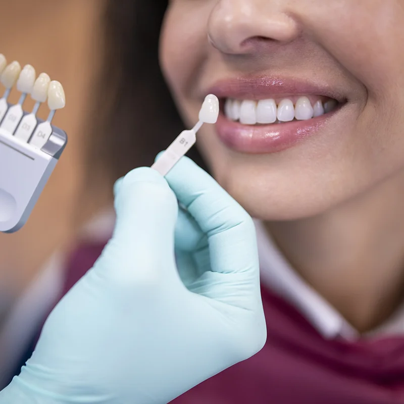 Dentist Color Matching Porcelain veneers