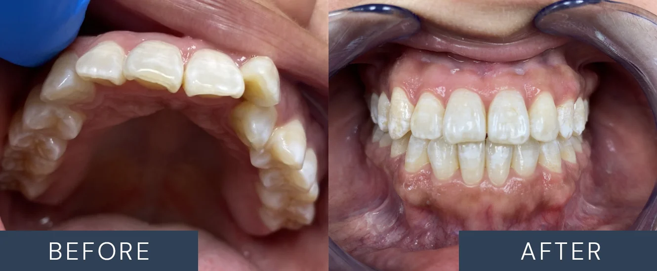 Invisalign Patient Before & After